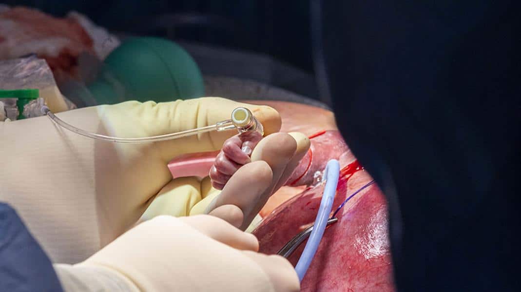 A Saudi doctor performs surgery on a fetus inside its mother's womb