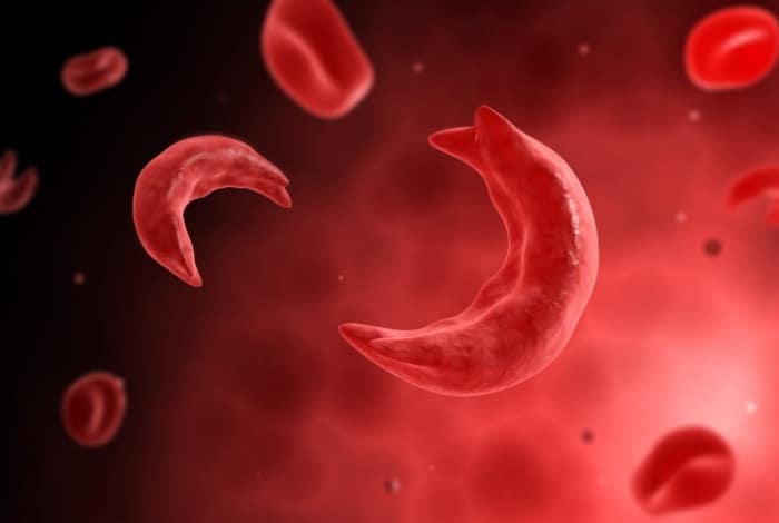 Saudi Doctor Develops Cure for Sickle Cell Anemia