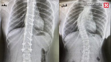 Al Habib Hospital Completes Successful Scoliosis Surgery