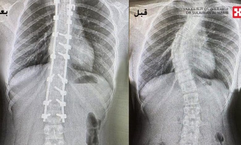Al Habib Hospital Completes Successful Scoliosis Surgery