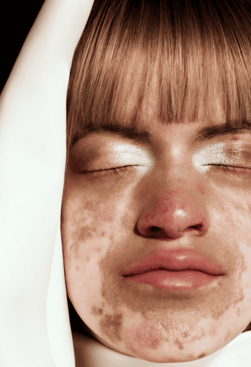 Butterfly Organization: Saudi Arabia’s Message of Hope to Rare Skin Patients